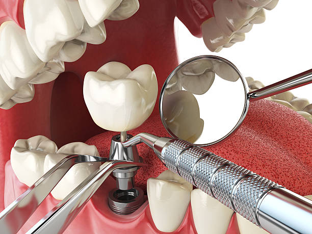 Best Emergency Dental Care for Broken or Chipped Teeth in Maxwell, CA